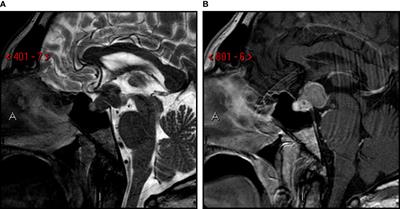 Case Report: Pituitary metastasis as a presenting manifestation of silent gastric cardia adenocarcinoma